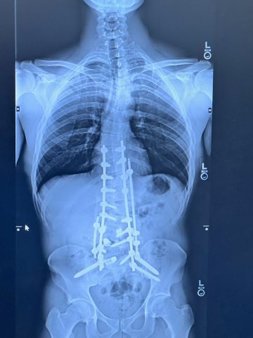Xray after a scoliosis surgery